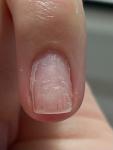 Темные полоски на ногте, опасно ли? фото 1