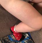 Ярко-розовые пятна на ножках у ребёнка фото 1