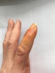 Инфекция Опух и покраснел палец после пореза болезненность бактерии фото 2