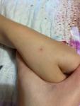 Пятно увеличивается у ребёнка на руке фото 3