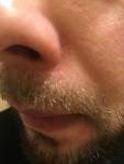Покраснение на складке носа фото 3