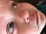 Увеличивающееся покраснение над верхней губой у ребёнка 2-х лет фото 3