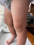 Сыпь на ногах у ребёнка 1,5 фото 2