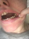 Потемнение зуба у десны фото 2