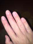 Атопический дерматит, грибок кожи рук и ногтей, что это? фото 2