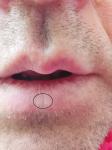 Бледный участок ткани на нижней губе фото 2