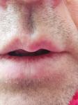 Бледный участок ткани на нижней губе фото 1