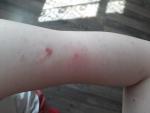 Красные пятна на руке, чешутся, не аллергия, возможно дерматит фото 1