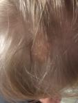 Лечение трихофития волосистой части головы фото 1