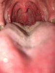 Сухость и боль в гортани, образования в горле фото 2