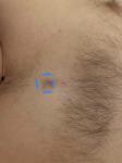 Шишка в волосистости части груди фото 2