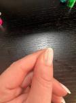Меланома ногтя или невус? Коричневая полоска на ногте фото 1