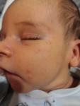 Возможно, что это аллергия или акне новорожденных? фото 3