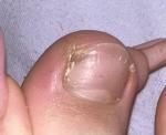Коричневое пятно на ногте ноги. До этого палец сильно болел фото 1
