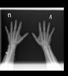Рентген определение зон роста фото 1