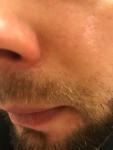 Покраснение на складке носа фото 1