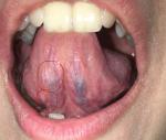 Белый налёт под языком (лейкоплакия?) фото 2