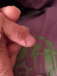 Кожа около ногтя ребёнка фото 1