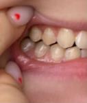 Кариес на зубах фото 1