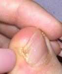 Коричневое пятно на ногте ноги. До этого палец сильно болел фото 2