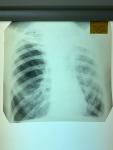 Помогите поставить диагноз по рентгену фото 2
