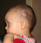 Гемангиома с височной стороны над ухом у ребенка фото 1