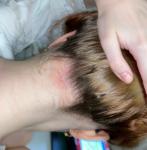 Покраснение и шелушение на коже головы с выпадением волос фото 1