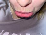 Шелушение слизистой губы фото 1