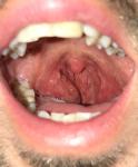 Тонзиллит, сухость во рту, вязкая слюна фото 1