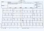 Расшифровка экг (гипотоник, бывает повышенное давление и учащение пульса) фото 1