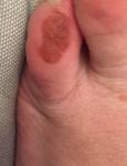 Темное пятно на пальце ноги фото 2