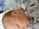 Акне новорождённых или аллергия фото 1