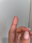 Аллергия на пальцах фото 5