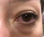 Красный глаз и дискомфорт при моргании фото 1