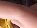 Красные пятна шершавые у ребёнка, аллергия? фото 1