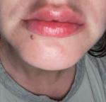 Комки в губах после увеличения спустя месяц фото 1