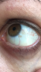 Пятна на белках глаз фото 1