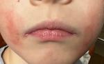 Красные сухие шелушащиеся пятна в уголках рта фото 1