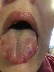 Жжение и отёк языка и губ фото 1