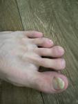 Странный цвет ногтя возможно грибок фото 3