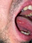 Появление шишки на корне языка, щипит фото 3