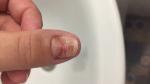 Как остановить скручивание ногтя после повреждения? фото 1