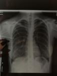 Плевро диафрагмальные спайки левого лёгкого фото 2