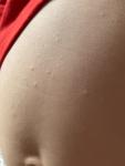 Сыпь на животе у ребёнка 2 года фото 2