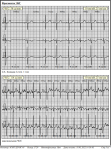 Холтеровское мониторирование, СА-блокады 2 степени фото 5