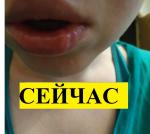 Травма губы (последствия спустя месяц) фото 18+ фото 5