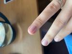 Продольная полоса на ногте. Меланома или гематома? фото 1
