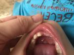 Зуб растет криво у ребенка фото 2