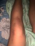 Травма коленного сустава/ушиб фото 1