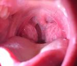 Опухоль в горле на миндалине фото 1